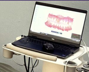 digital dental scanner clear aligner Bonita Springs