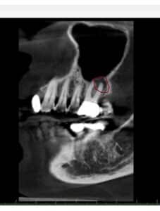 Cone Beam CT scan showing infection around a tooth root not visible on a 2D dental X-ray